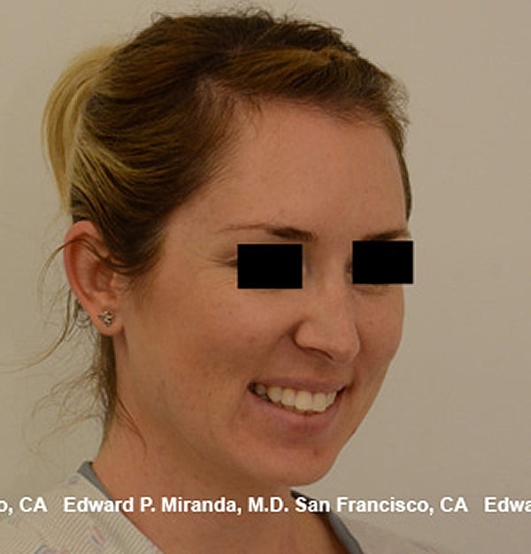 Rhinoplasty Before & After