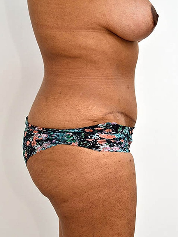 Tummy Tuck Before & After