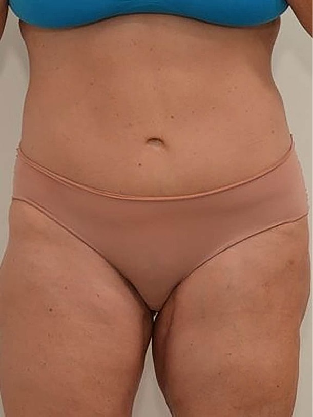 Tummy Tuck Before & After