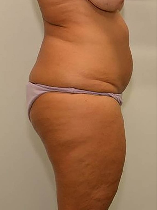 Tummy Tuck Before & After