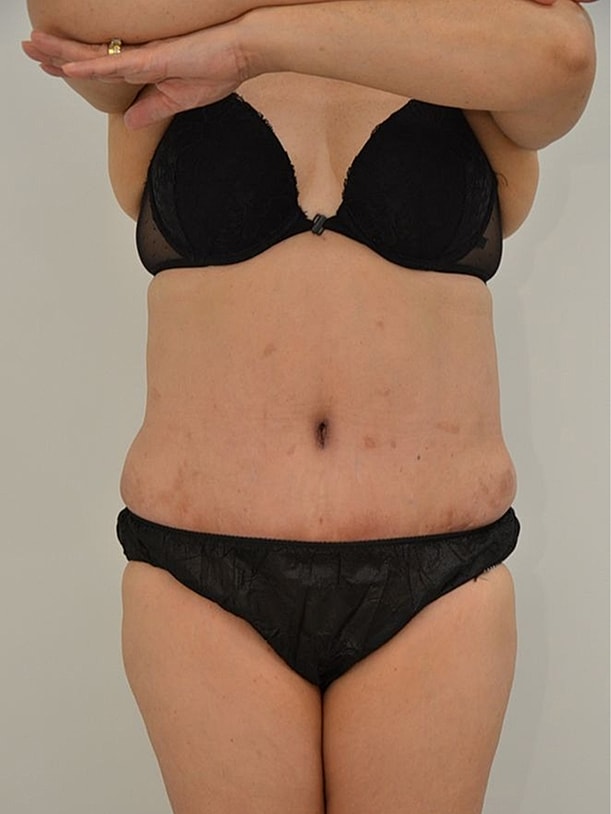 Tummy Tuck Before & After