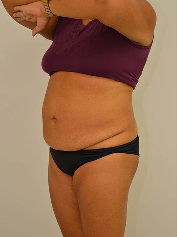 Tummy Tuck Before & After