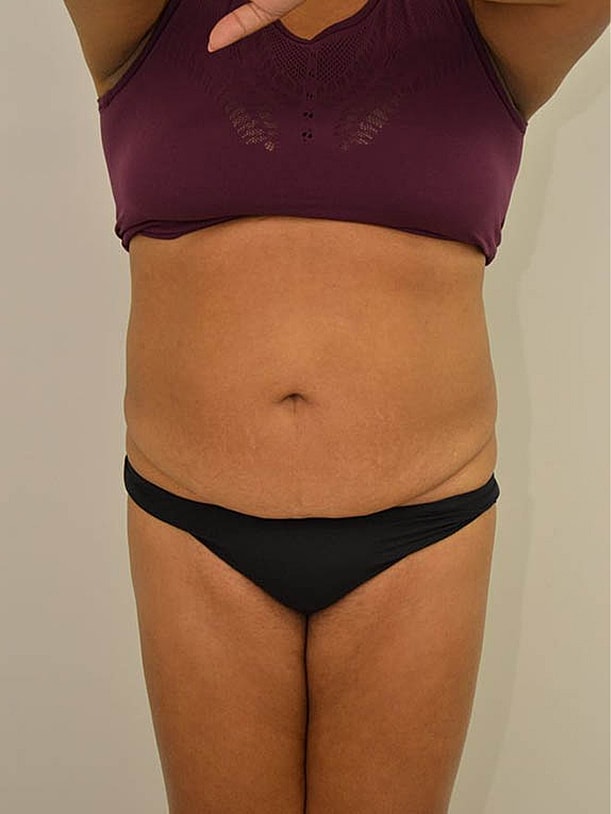Tummy Tuck Before & After