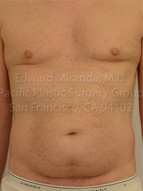 Tummy Tuck Before & After