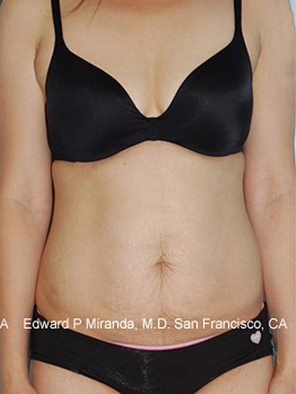 Tummy Tuck Before & After