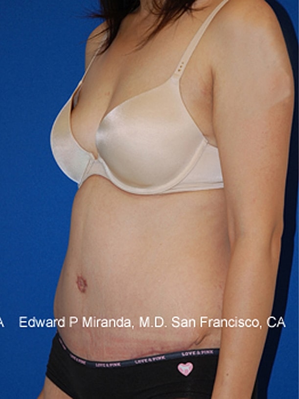Tummy Tuck Before & After