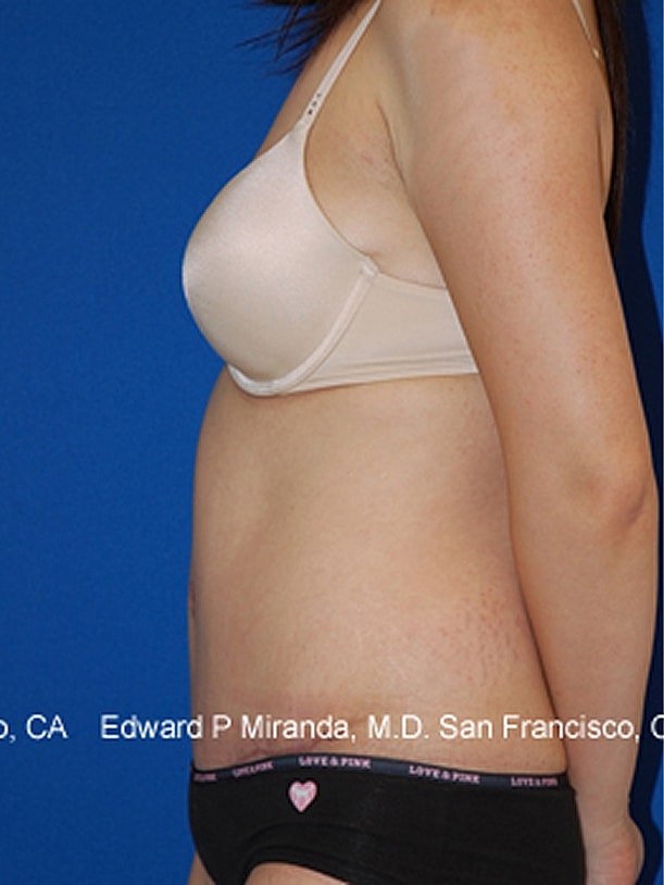 Tummy Tuck Before & After
