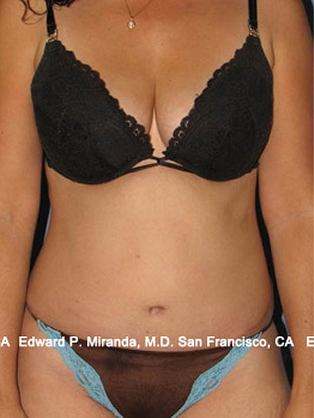 Tummy Tuck Before & After