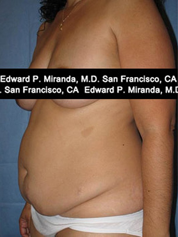 Tummy Tuck Before & After