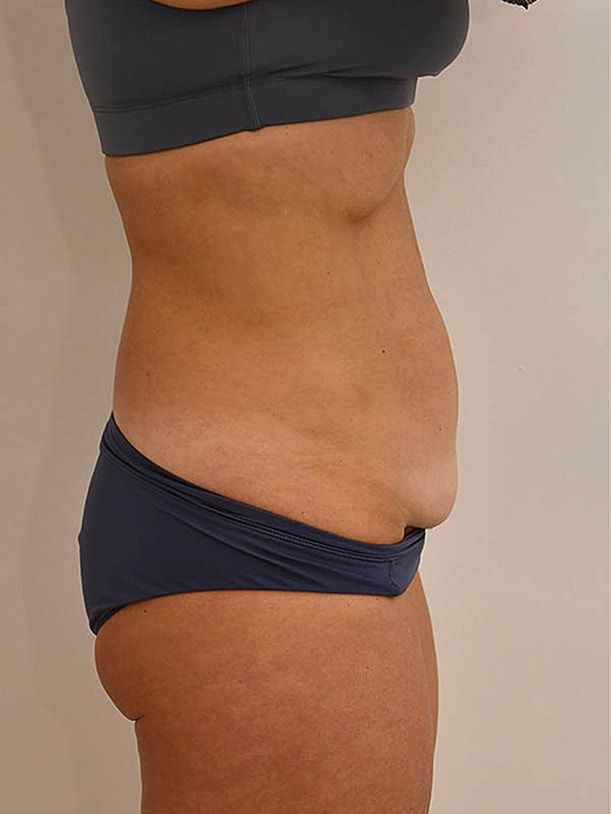 Tummy Tuck Before & After