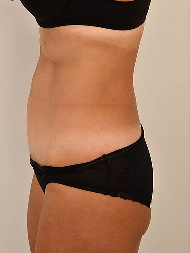 Tummy Tuck Before & After