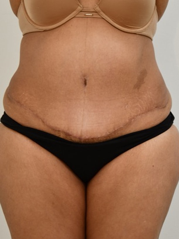 Body positive image of abdomen with stretch marks.