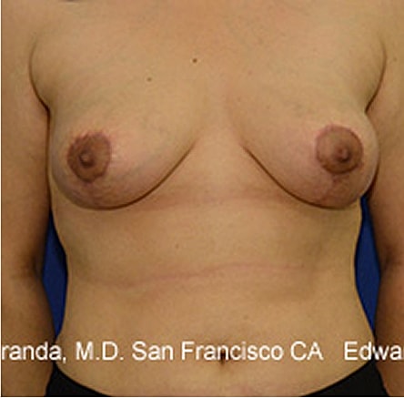 Breast Lift Before & After