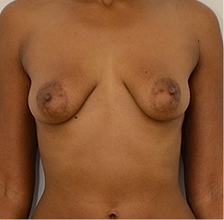 Breast Lift Before & After