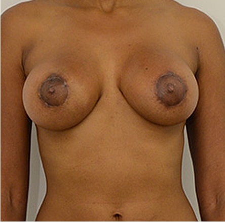 Breast Lift Before & After