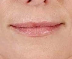Juvederm Before & After