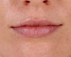 Juvederm Before & After