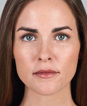 Juvederm Before & After