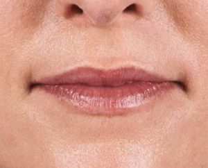 Juvederm Before & After
