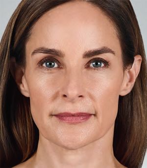 Juvederm Before & After