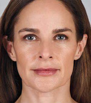 Juvederm Before & After