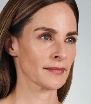 Juvederm Before & After