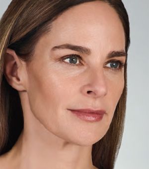 Juvederm Before & After