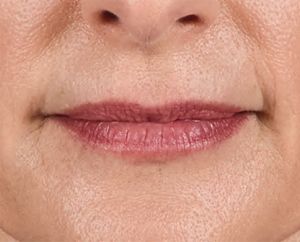 Juvederm Before & After
