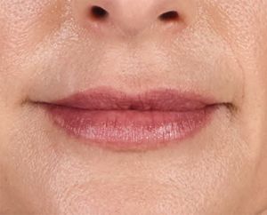 Juvederm Before & After