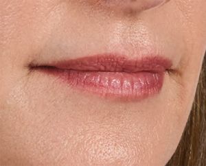 Juvederm Before & After