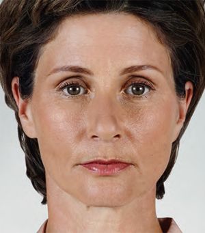 Juvederm Before & After