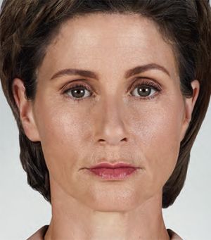 Juvederm Before & After