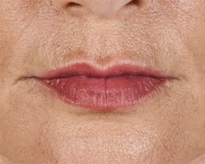 Juvederm Before & After