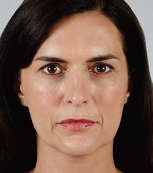 Juvederm Before & After