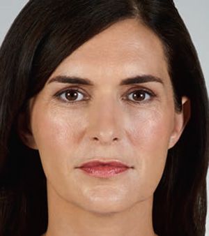 Juvederm Before & After