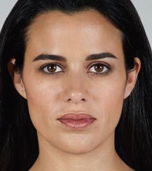 Juvederm Before & After