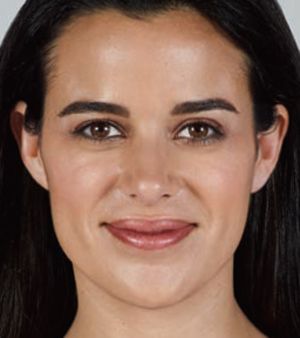 Juvederm Before & After