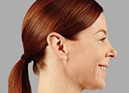 Juvederm Before & After