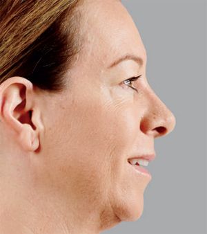 Juvederm Before & After