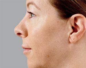 Juvederm Before & After