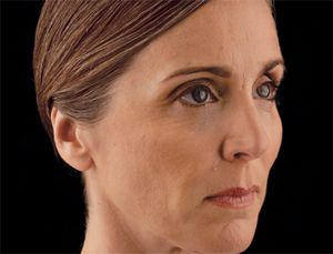 Juvederm Before & After