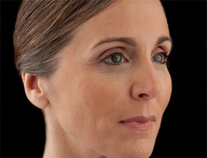 Juvederm Before & After