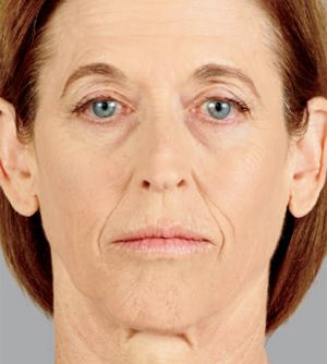 Juvederm Before & After