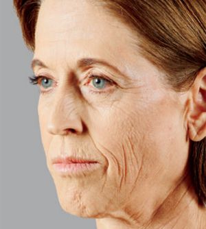 Juvederm Before & After