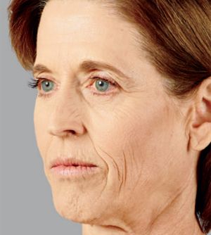 Juvederm Before & After