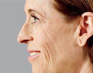 Juvederm Before & After