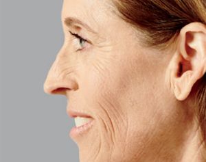 Juvederm Before & After