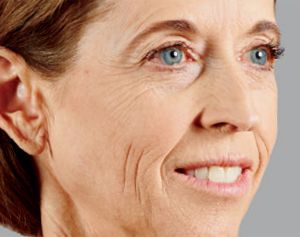 Juvederm Before & After