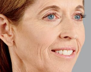 Juvederm Before & After