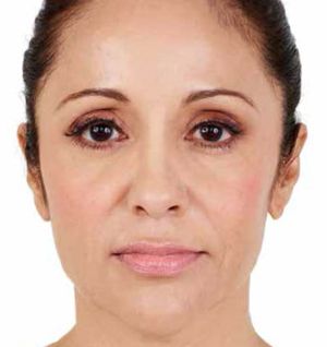 Juvederm Before & After